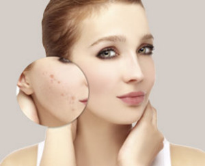 serv-acne-2