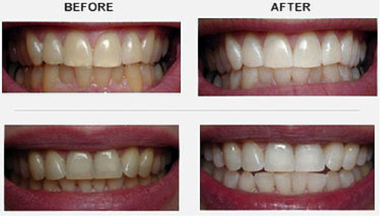 teeth-whitening